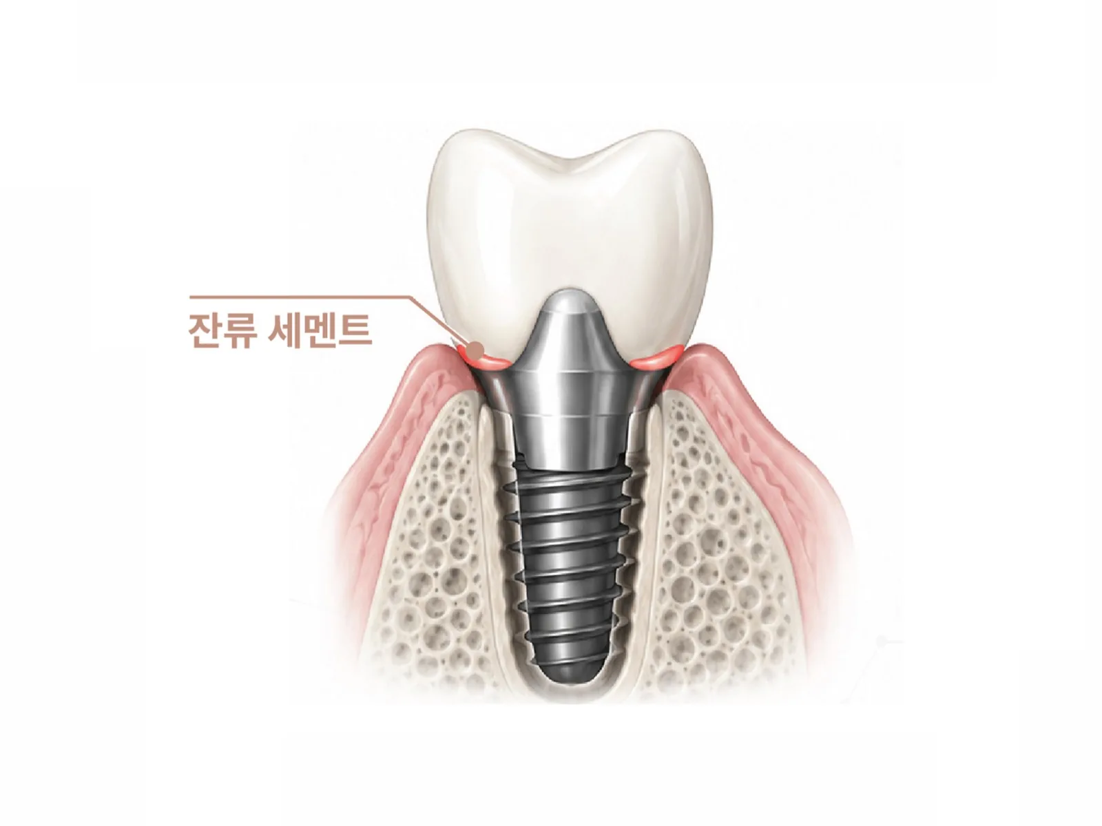 잇몸 아래 잔류 세멘트를 표시한 임플란트 단면 일러스트